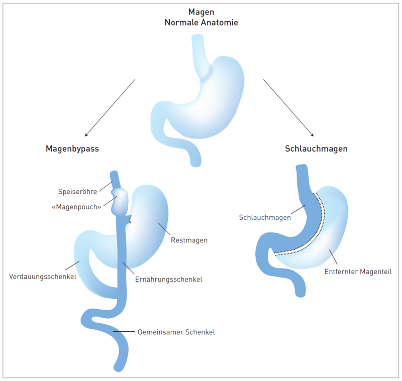 SoH | Bariatrische Chirurgie | Kantonsspital Olten